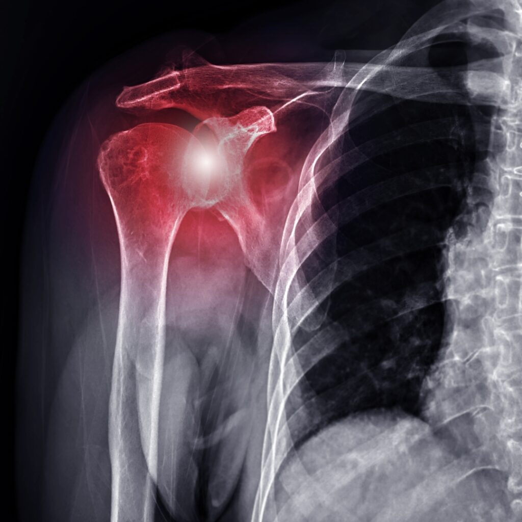 Shoulder & Clavicle Fracture Surgery